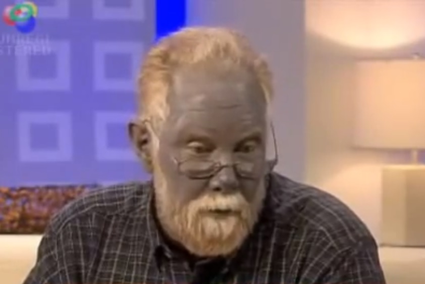 Синяя кожа у человека