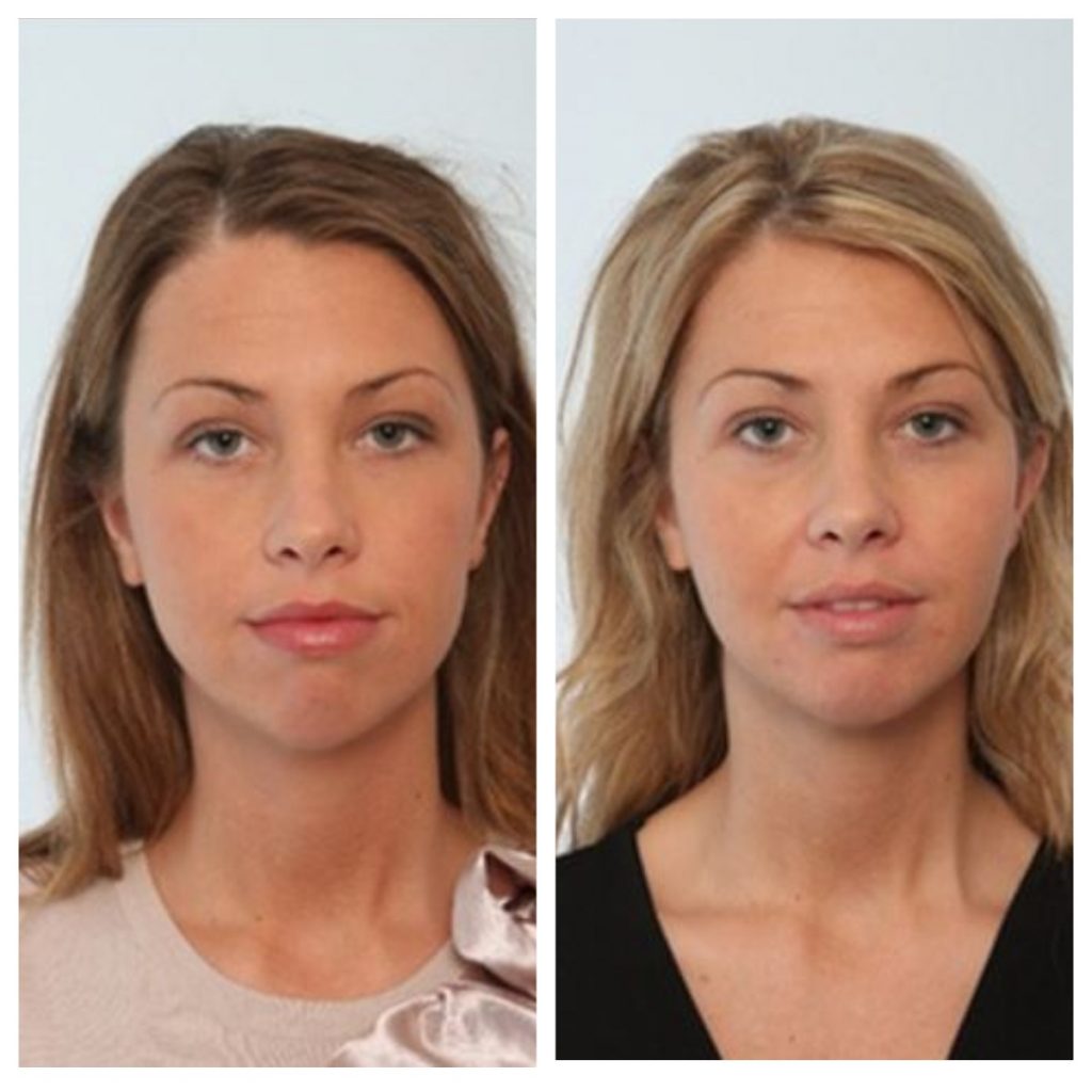 Мешки биша фото до и после женщины