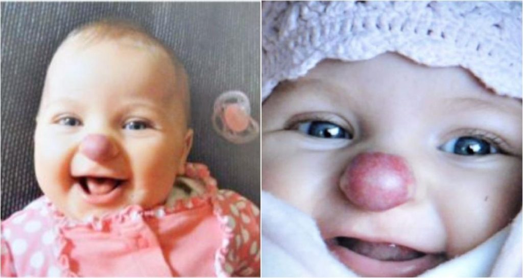 Ребенок родился с клоунским носиком: как спустя 3 года выглядит эта девочка